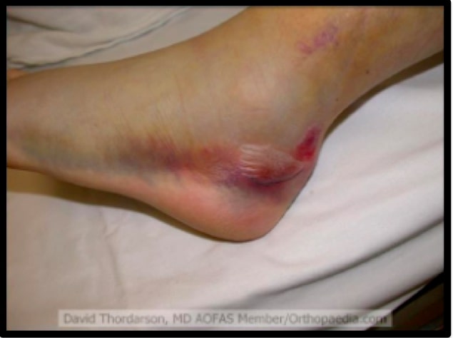 File:Clinical calcaneal fracture.jpg