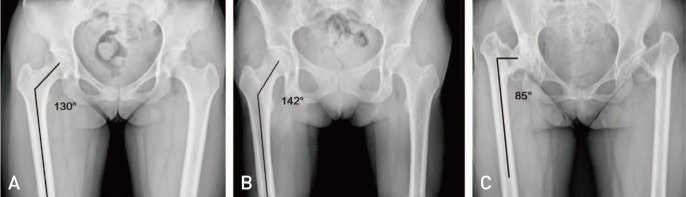 File:Hip neck shaft angle of inclination.jpg