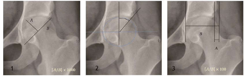 Acetabular depth ratio (1), lateral centre edge angle (2), femoral extrusion (3)