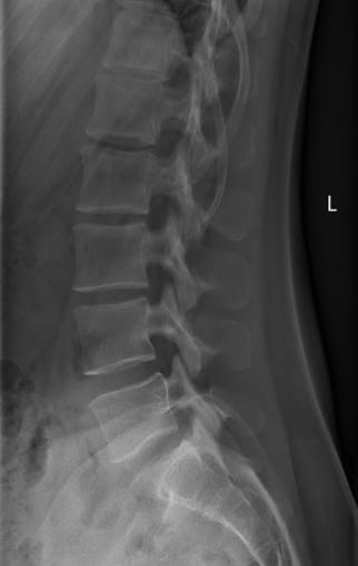 File:Lumbar Spine Lateral Radiograph Normal.png