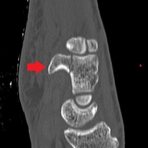 Hamate fracture on CT.jpg