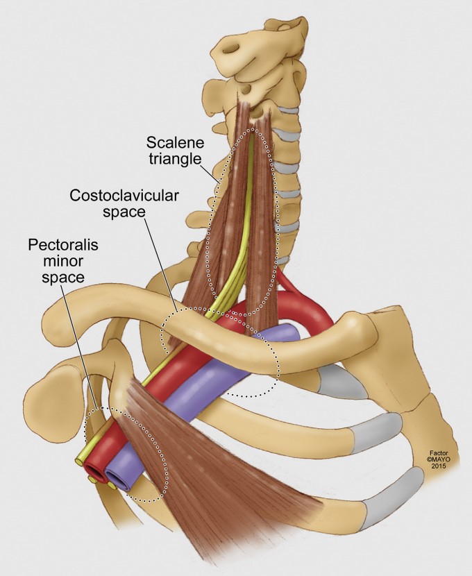 Thoracic outlet syndrome compression.jpg