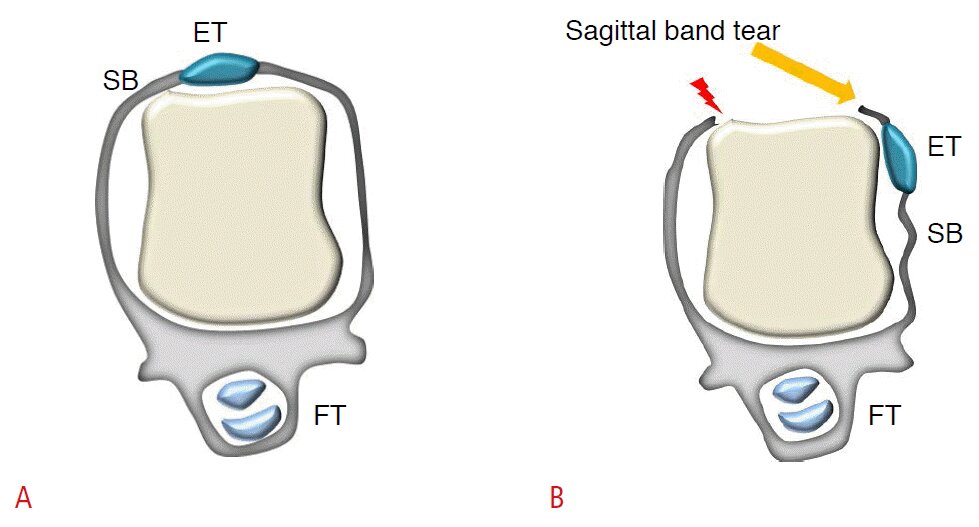 Sagittal band tear.jpg