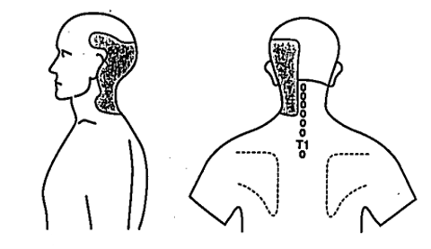 File:Atlanto-occipital joint pattern dreyfuss.png