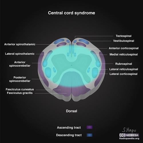 File:Incomplete-spinal-cord-syndromes-illustrations central.jpg