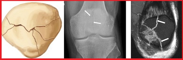 File:Patellar stellate fracture.jpg
