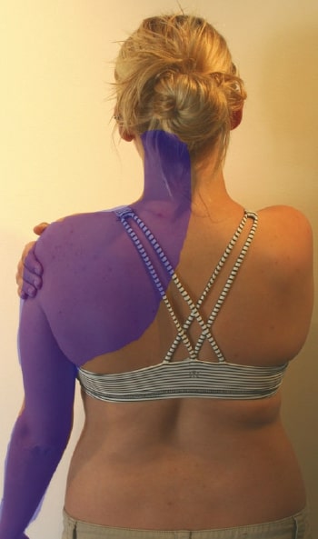 File:Pain pattern thoracic outlet syndrome.jpg