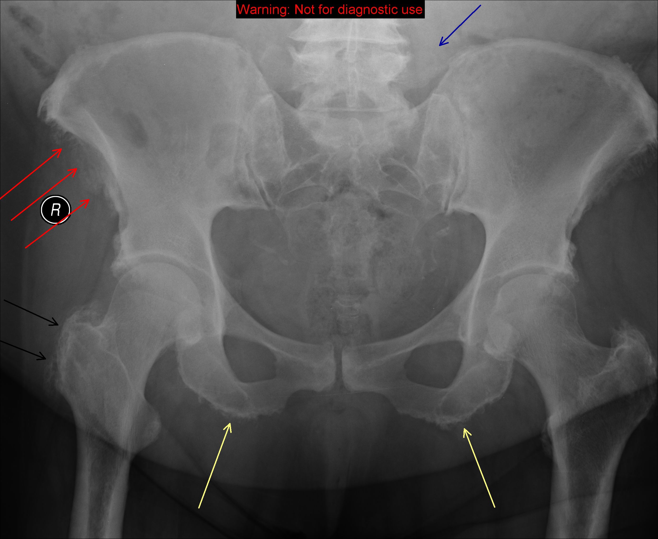 Разрыв крестцов. Перелом подвздошной кости рентген. Оссификаты тазобедренного сустава. Тендиноз тазобедренного сустава рентген. Энтезопатия седалищного бугра.