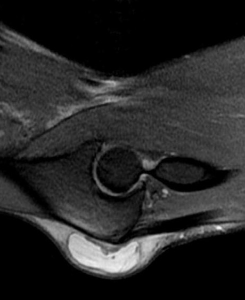 Olecranon bursitis MRI.png
