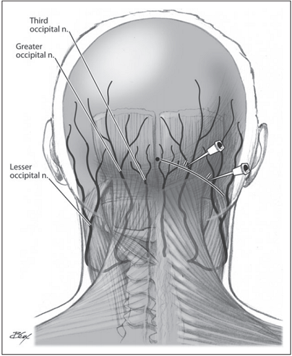 File:Greater-and-lesser-occipital-nerve-blocks.png