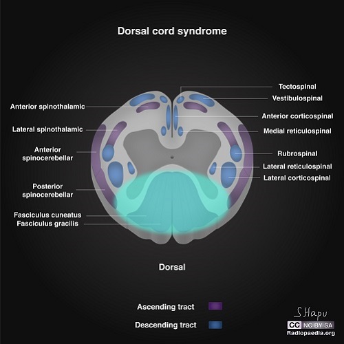 File:Incomplete-spinal-cord-syndromes-illustrations dorsal.jpg