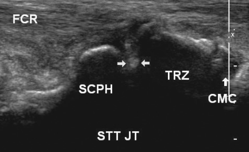 On ultrasound the needle is an echogenic dot (horizontal arrows) between the scaphoid (SCPH) and trapezium (TRZ). Also seen are the carpometacarpal joint (CMC) to the right of the STT joint (STT JT), and the flexor carpi radialis tendon (FCR). Bottom is deep; left, proximal; right, distal; and top, superficial. ©2011 by the American Institute of Ultrasound in Medicine[1]