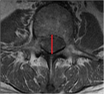 CLSS MRI AP diameter.jpg