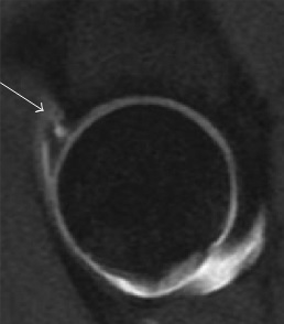 Sagittal T1 MRI of labral tear.jpg