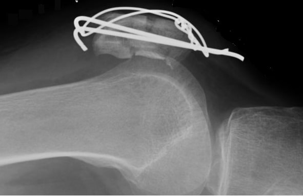 File:Patellar fracture tension band.jpg
