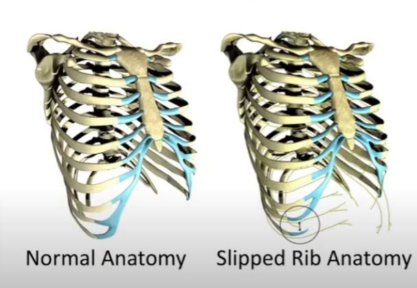 File:Slipped rib anatomy.png