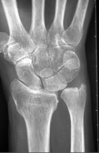 File:Xray positive ulnar variance.png
