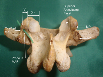 Dorsal aspect of the third lumbar vertebra showing a probed MAF on the left. mamillary process (MP), accessory process (AP), mamillo-accessory foramen (MAF), mamillo-accessory ligament (MAL).[2]