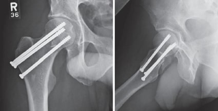 File:Hip fracture screws xr.jpg