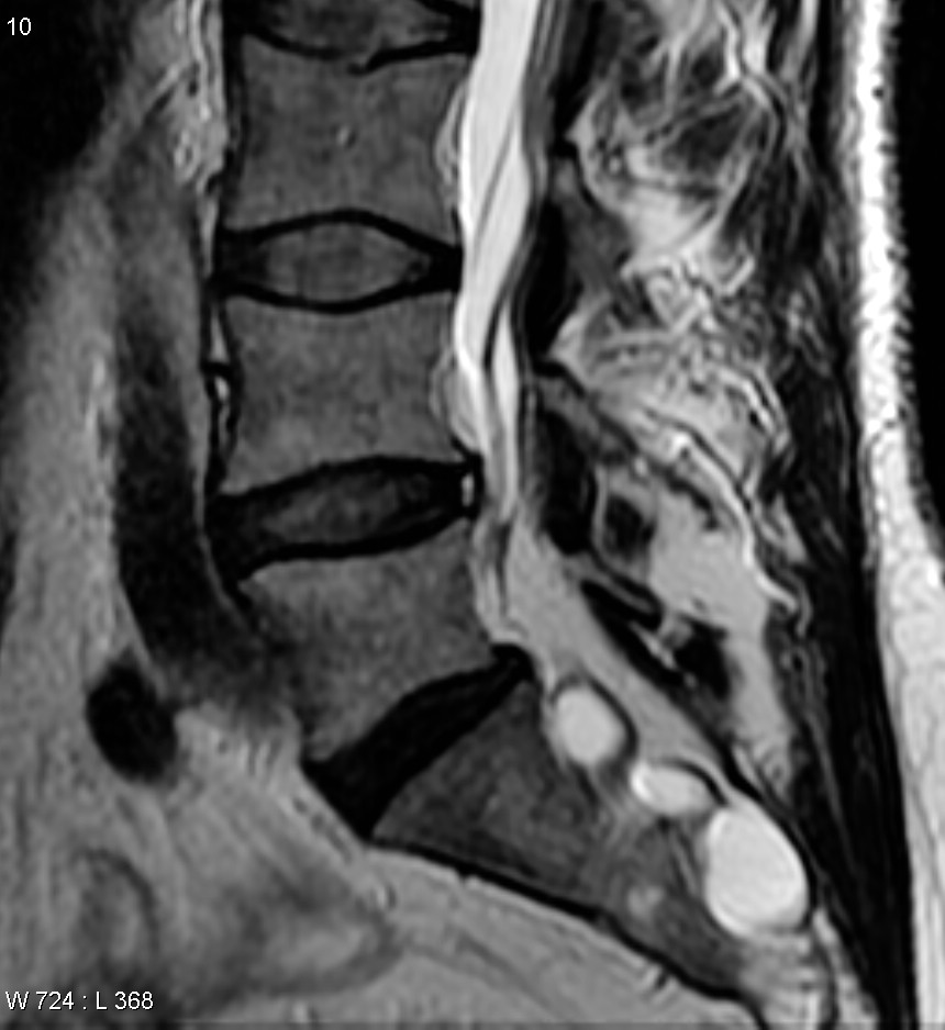 Tarlov cyst and annular fissure.jpg