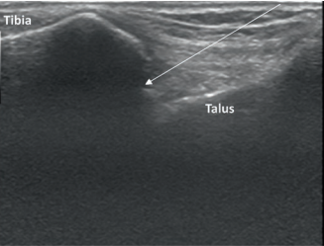 File:Tibiotalar joint injection ultrasound long axis2.png