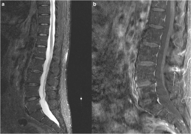 File:Baastrup kissing spine interspinous oedema MRI.jpg