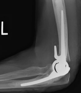 Distal humerus fracture after arthroplasty.jpg