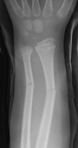 Figure 1: X-ray of a greenstick fracture.