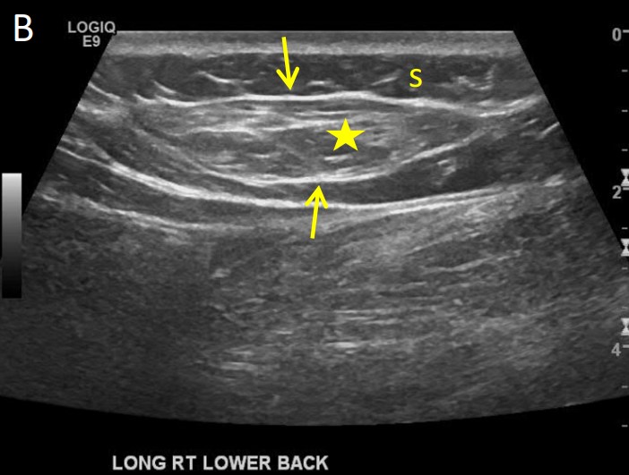 File:Subfascial herniation ultrasound.jpg