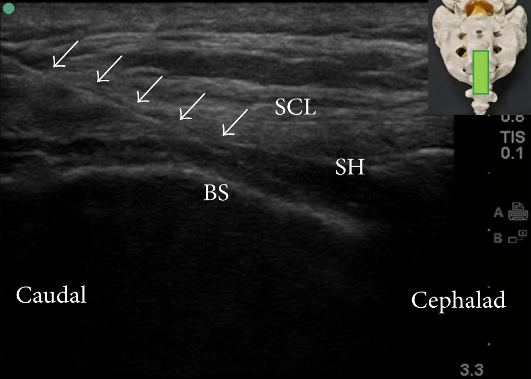 Caudal epidural ultrasound longitudinal.jpg