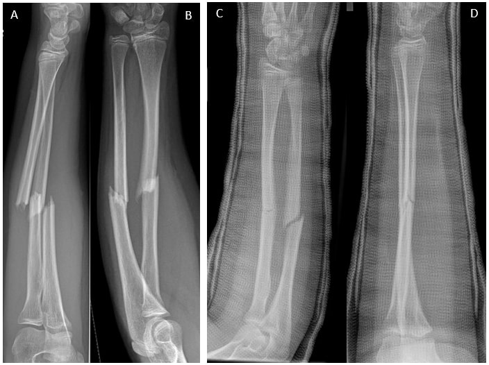 File:Both bone forearm fracture.jpg