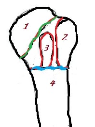 Figure 1: The four osseous segments are humeral head and articular surface (1), greater tuberosity (2), lesser tuberosity (3) and humeral shaft (4). The so-called anatomic neck is shown in green; this represents the fused epiphyseal plate below the articular surface. The so-called surgical neck is shown in blue. This is the junction between the shaft and the tuberosities. The bicipital groove lies between the greater and lesser tuberosities.