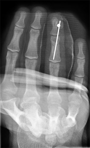 File:Surgical fixation phalanx fracture.jpg