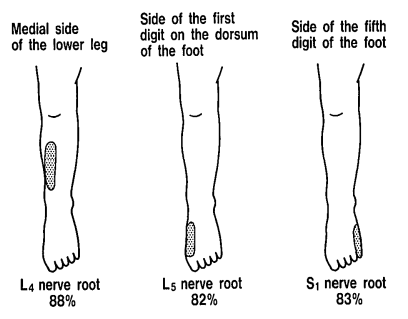 Distinctive regions. L4 is medial side of the lower leg in 88%. L5 is first dorsal digit in 82%. S1 is lateral side of 5th digit in 83%.