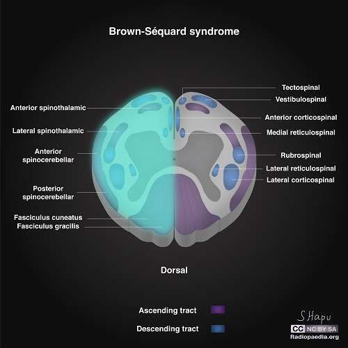 File:Incomplete-spinal-cord-syndromes-illustrations brown sequard.jpg