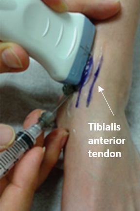 Tibiotalar joint injection ultrasound long axis.png