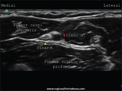 File:Ultrasound Ulnar Nerve.png