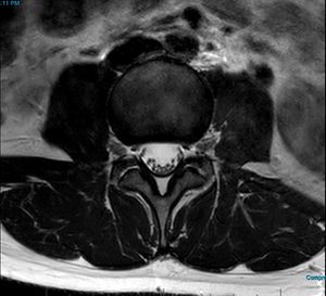 MRI T2 Lumbar Spine L3-L4 Transarticular Axial.jpg