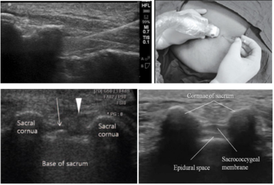 Caudal Epidural Injection Ultrasound.PNG