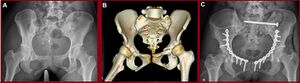 Pelvic fracture xr ct and surgery.jpg