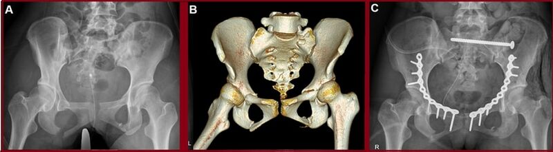 File:Pelvic fracture xr ct and surgery.jpg