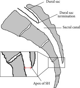 Sagittal view of the sacrum showing the sacral canal