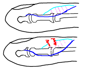 Figure 4: Central slip injury. An injury to the central slip (sky blue) can cause the lateral bands (dark blue) to fall toward the volar side of the finger and make them flexors of the PIP joint.