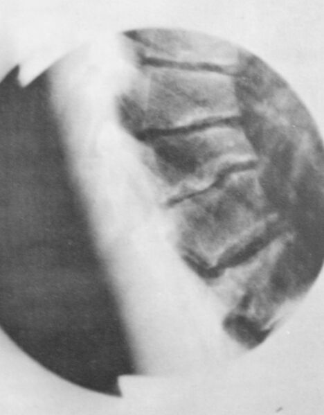 File:Scheuermann signs of lateral radiograph.jpg