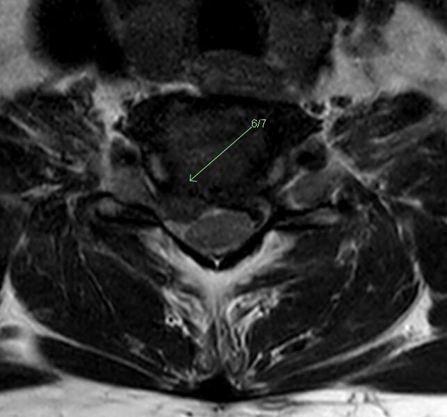 File:Right C6-7 disc protrusion MRI axial.jpg