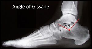 Figure 9: Angle of Gissane (Normal)
