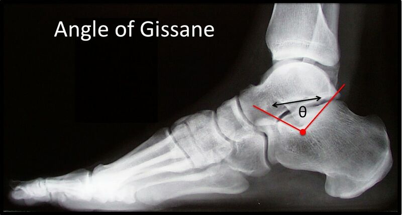 File:Angle of gissane foot.jpg