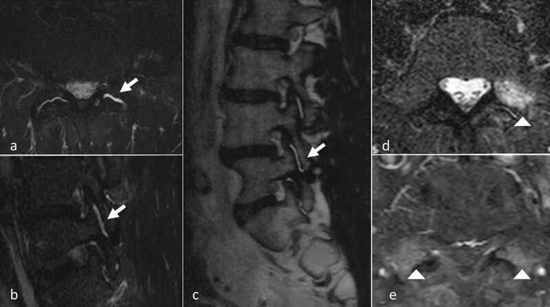 File:Lumbar facet joints MRI oedema.jpg