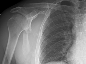 Figure 4: Plain radiography showing a comminuted and displaced fracture of the scapular body. On this x-ray, there is no clear extension of a fracture in to the glenoid. (Figures 4-6 Case Courtesy of Ms. Kayla H, Radiopaedia.org, rID: 72794)