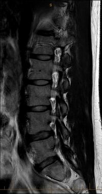 MRI T2 Lumbar Spine Sagittal Transpedicular.jpg
